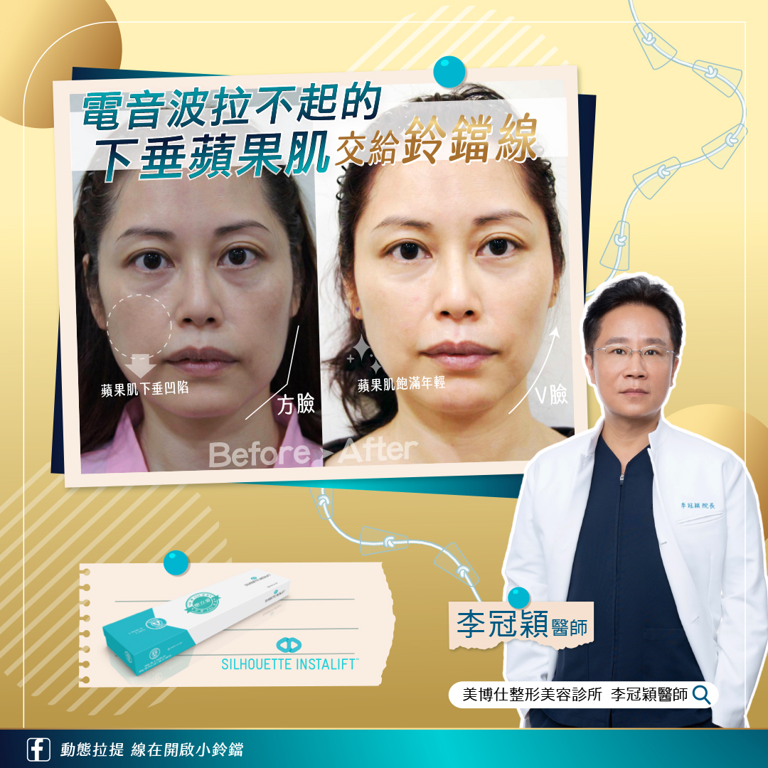 李冠穎醫師對於鈴鐺線的拉提效果非常滿意 李冠穎醫師對於鈴鐺線的拉提效果非常滿意