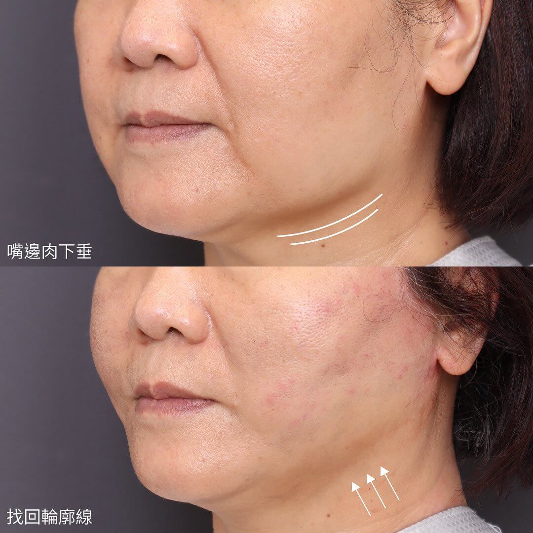 下垂嘴邊肉可以靠鈴鐺線消除、獲得俐落分明下顎線輪廓的效果 下垂嘴邊肉可以靠鈴鐺線消除、獲得俐落分明下顎線輪廓的效果