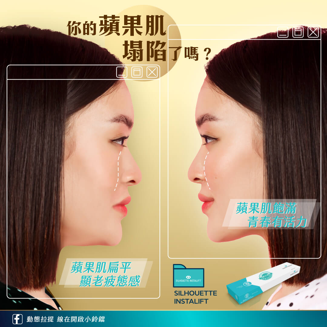 蘋果肌下垂凹陷壓出法令紋,是顴骨脂肪墊移位所導致 蘋果肌下垂凹陷壓出法令紋,是顴骨脂肪墊移位所導致