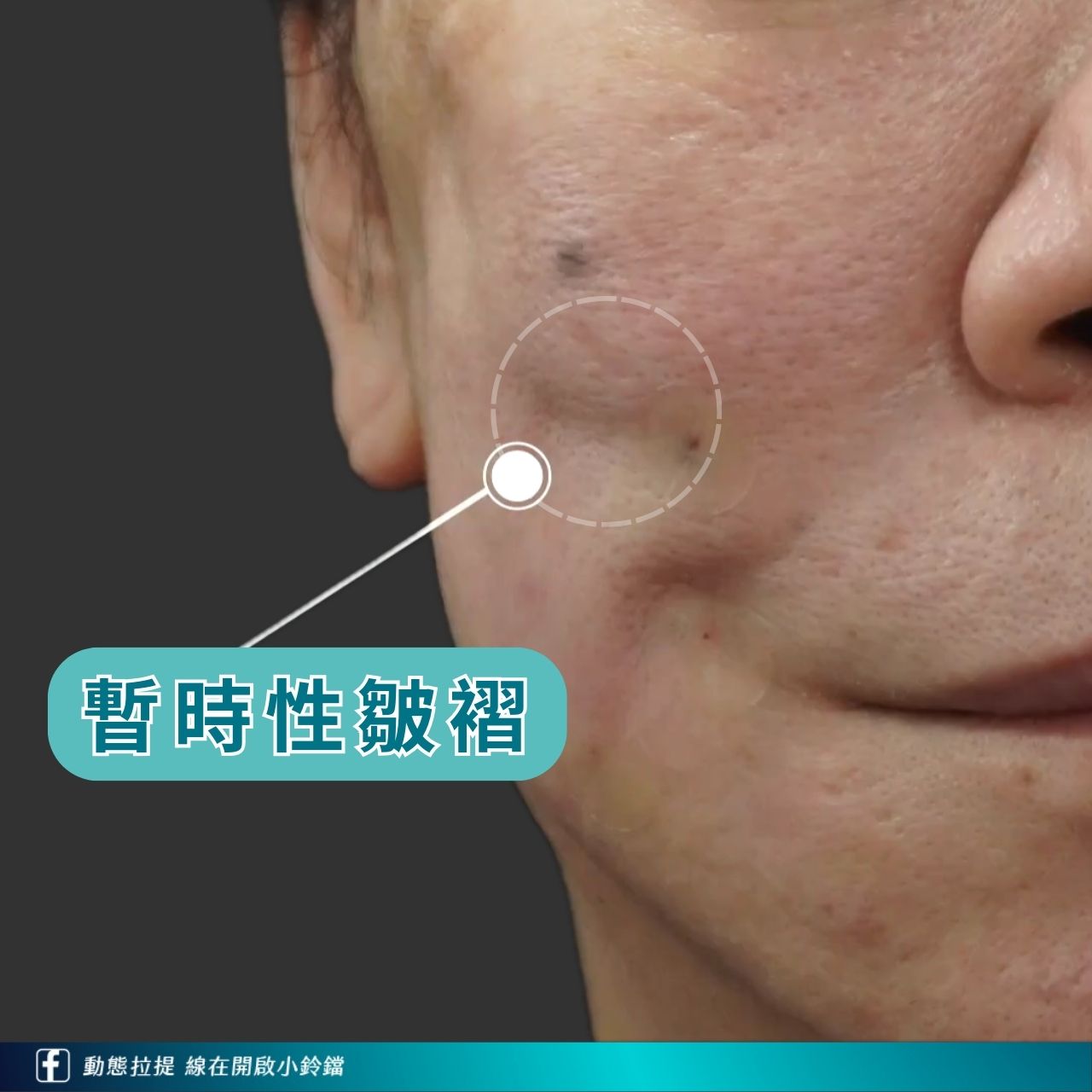 鈴鐺線術後恢復期若出現凹凸不平或皺褶,並非失敗而是可能為暫時性的併發症 鈴鐺線術後恢復期若出現凹凸不平或皺褶,並非失敗而是可能為暫時性的併發症