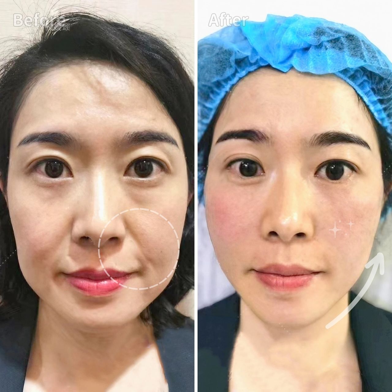 王祚軒醫師使用鈴鐺線合併洢蓮絲改善嘴邊肉、法令紋等問題 王祚軒醫師使用鈴鐺線合併洢蓮絲改善嘴邊肉、法令紋等問題