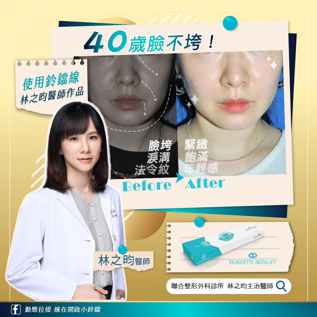 玻尿酸打蘋果肌凹陷的方法不對會形成饅化臉,林之昀醫師建議選用鈴鐺線 玻尿酸打蘋果肌凹陷的方法不對會形成饅化臉,林之昀醫師建議選用鈴鐺線