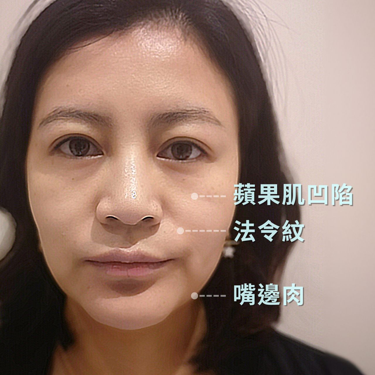 蘋果肌增生、淡化法令紋、俐落下顎線,可靠鈴鐺線一次達成 蘋果肌增生、淡化法令紋、俐落下顎線,可靠鈴鐺線一次達成