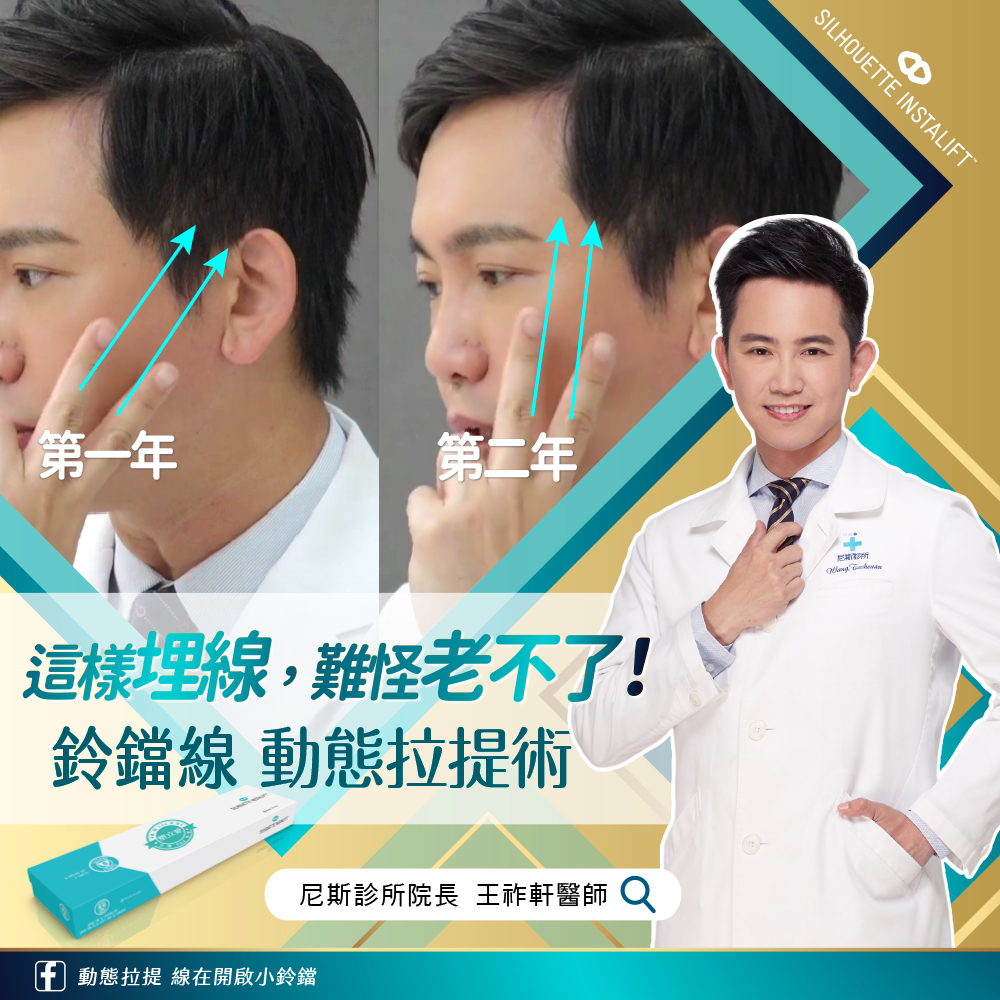 王祚軒醫師使用鈴鐺線,避免埋線拉提凹凸不平副作用 王祚軒醫師使用鈴鐺線,避免埋線拉提凹凸不平副作用